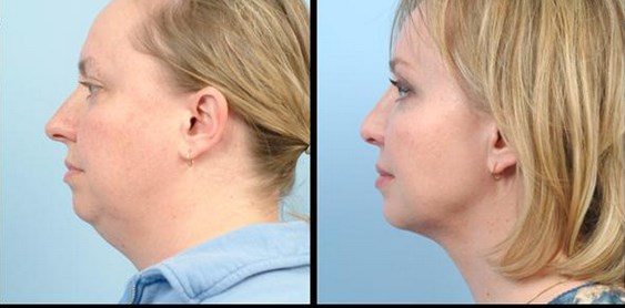 Ліпосакція шиї та обличчя
