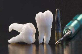 Вся правда об имплантации зубов
