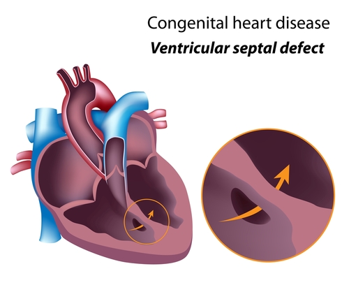 congenital heart disease - ventricular septal defect